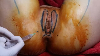 7. Labia Majora plasty