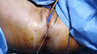 10. Labia Majora plasty