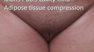 3. Labia Majora plasty