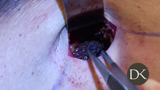 Stay At Home Mom Gets Huge Implants 0:52, 4:02