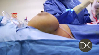 6. Stay At Home Mom Gets Huge Implants 0:52, 4:02