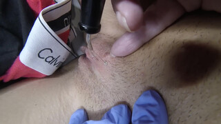 6. Vaginal Skin Tag Removal