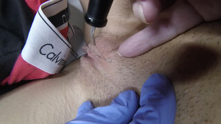 3. Vaginal Skin Tag Removal