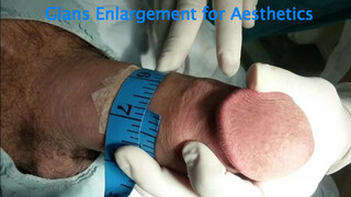 Penis enlargement surgery with Huge one at 2:57