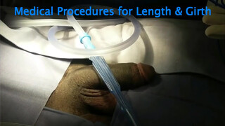 1. Penis enlargement surgery with Huge one at 2:57