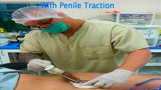 7. Penis enlargement surgery with Huge one at 2:57