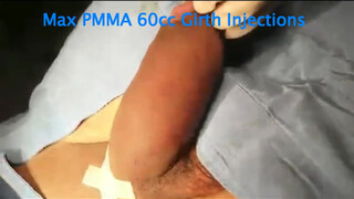 3. Penis enlargement surgery with Huge one at 2:57