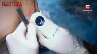 6. Russian video. Examination and treatment of labial papilloma. 4:38