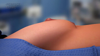 7. Zvětšení prsou anatomickým implantátem