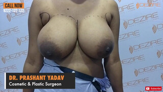 1. Female Scarless Breast Reduction Dr. Prashant . Dezire Clinic India