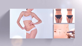1. Liposuction medical video (full frontal with tight shaved pussy)