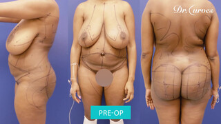 Woman Gets Breast Reduction to Improve Quality of Life
