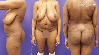 8. Woman Gets Breast Reduction to Improve Quality of Life