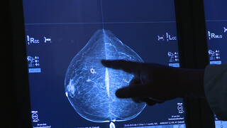 7. Czech mammogram and ultrasound